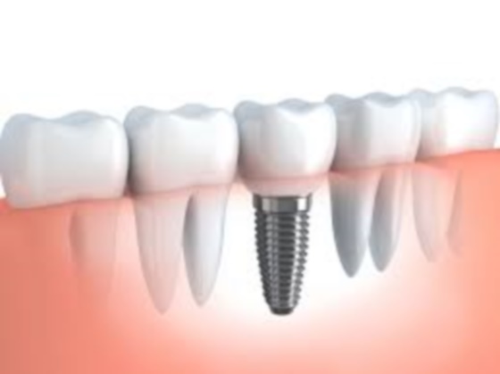מדוע יש צורך בהשתלת עצם והרמת סינוס בתהליך השתלת שיניים?